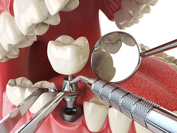 Best Dentist for Tooth Abscess  in Wliamsvle, IL